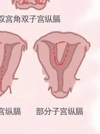 有子宫内膜异位症试管移植6次都失败了接下来该怎么办？
